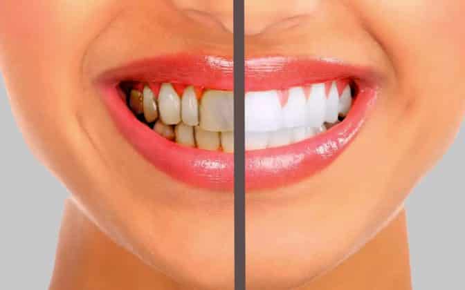 Diş taşı nedir? Neden oluşur? Nasıl tedavi edilmeli?