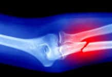 Kırık kemiklerin kaynamamasında sigaranın etkisi var mı? kırık kemiklerin kaynamasında