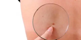 Cilt kanserinde erken teşhis hayat kurtarıyor: Belirtileri neler? Cilt kanserinde erken teşhis