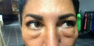 Göz altı ışık dolgusu yaptırdı, yüz felci geçirdi: Doktor, aile hekimi çıktı!