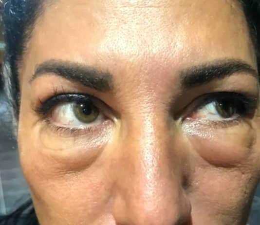 Göz altı ışık dolgusu yaptırdı, yüz felci geçirdi: Doktor, aile hekimi çıktı!