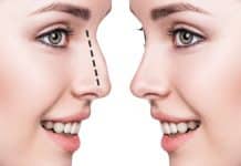 Burun estetiği Rinoplasti nedir? Nasıl yapılır? Burun estetiği