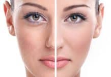 Altın İğne Nedir? Altın iğne nedir