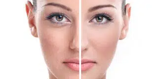 Altın İğne Nedir? Altın iğne nedir