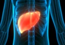 Karaciğer yağlanması nedir? Belirtileri nelerdir? karaciğer yağlanması