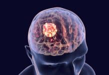 beyin tümörünün belirtisi