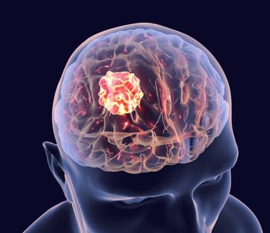 beyin tümörünün belirtisi