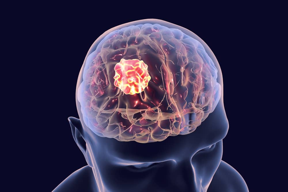 beyin tümörünün belirtisi