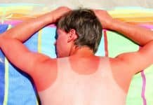 Güneş yanığı durumunda bunları sakın yapmayın! Güneş yanığı