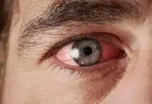 Adenovirüs en yaygın belirtisi gözlerde kızarıklık Adenovirüs