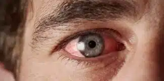 Adenovirüs en yaygın belirtisi gözlerde kızarıklık Adenovirüs