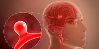 Anevrizma nedir? Şiddetli baş ağrısının nedeni olabilir! Anevrizma nedir
