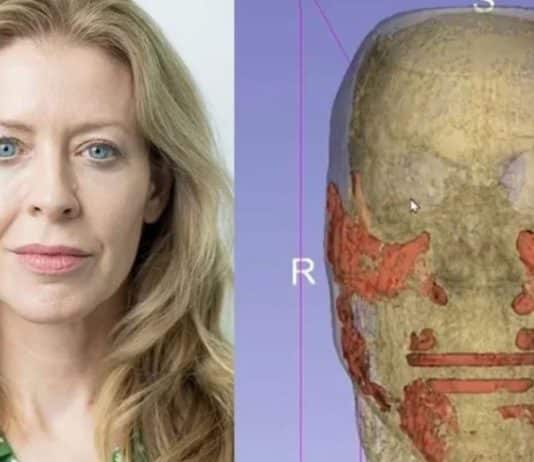 Botoksun verdiği hasar