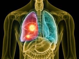 Akciğer kanserinin belirtisi