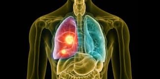 Akciğer kanserinin belirtisi