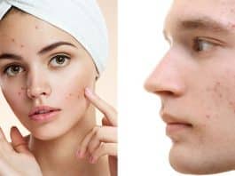 Sivilcelerden kurtulmanın yolları