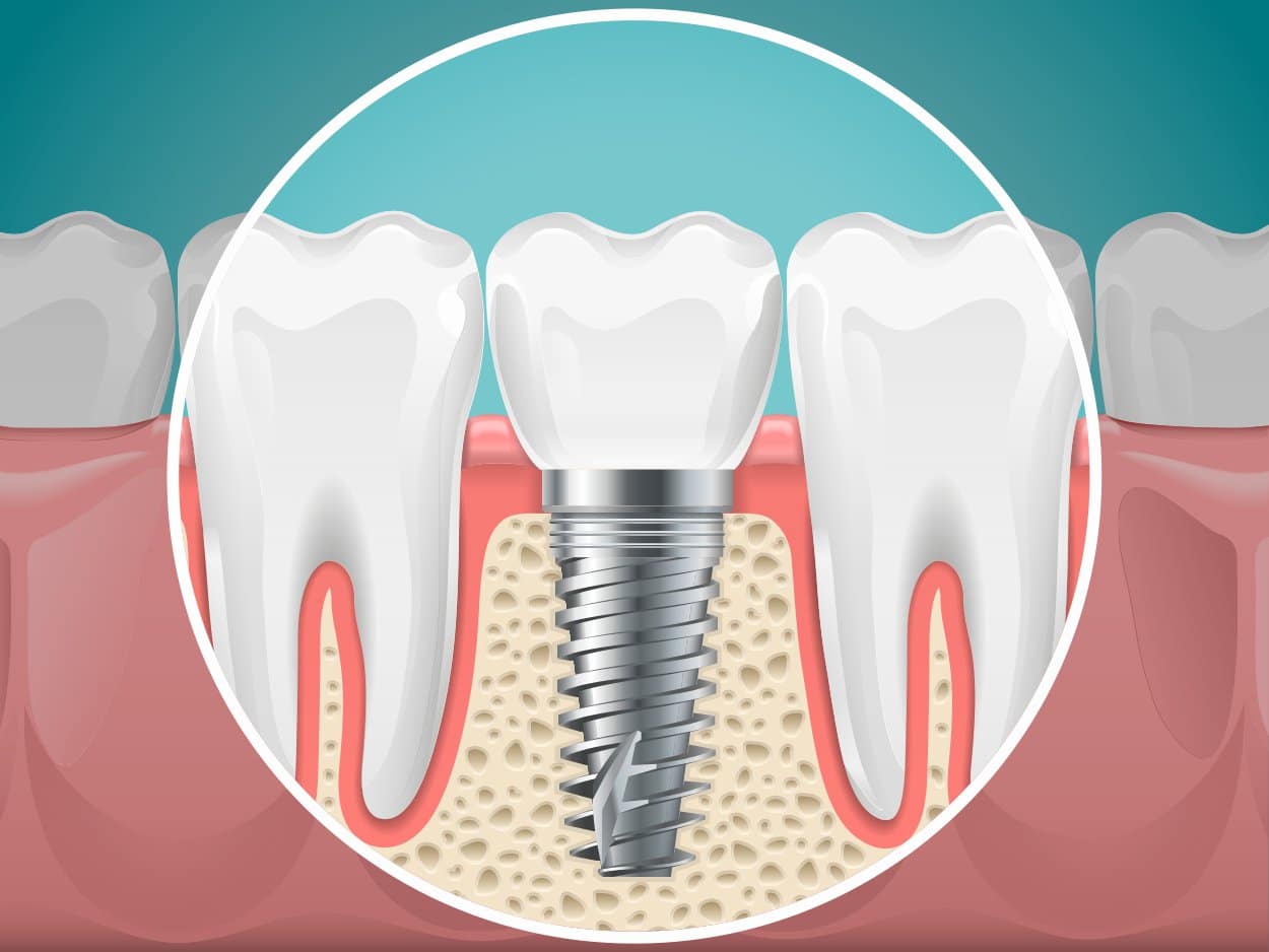 diş implantı tedavisi