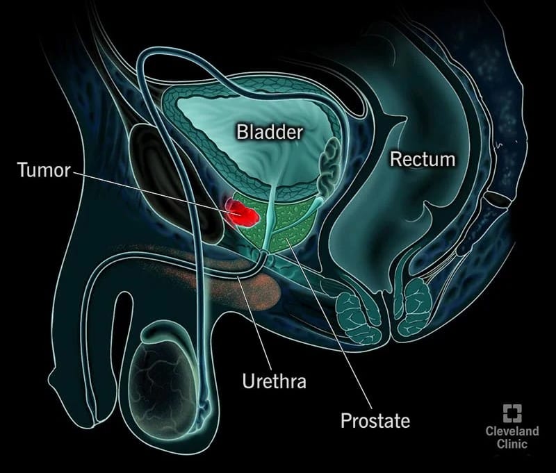 prostat büyümesi tümör