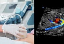 Renkli Doppler Ultrason Renkli Doppler Ultrason