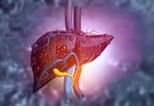 Karaciğerde yağlanma nasıl belirlenebilir? Karaciğerde yağlanma