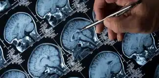 Alzheimer’ın belirtileri ortaya çıkmadan önce tespit edilmesini sağlayacak yöntem Alzheimer