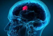 Baş ağrısı beyin tümörü habercisi olabilir mi? beyin tümörü