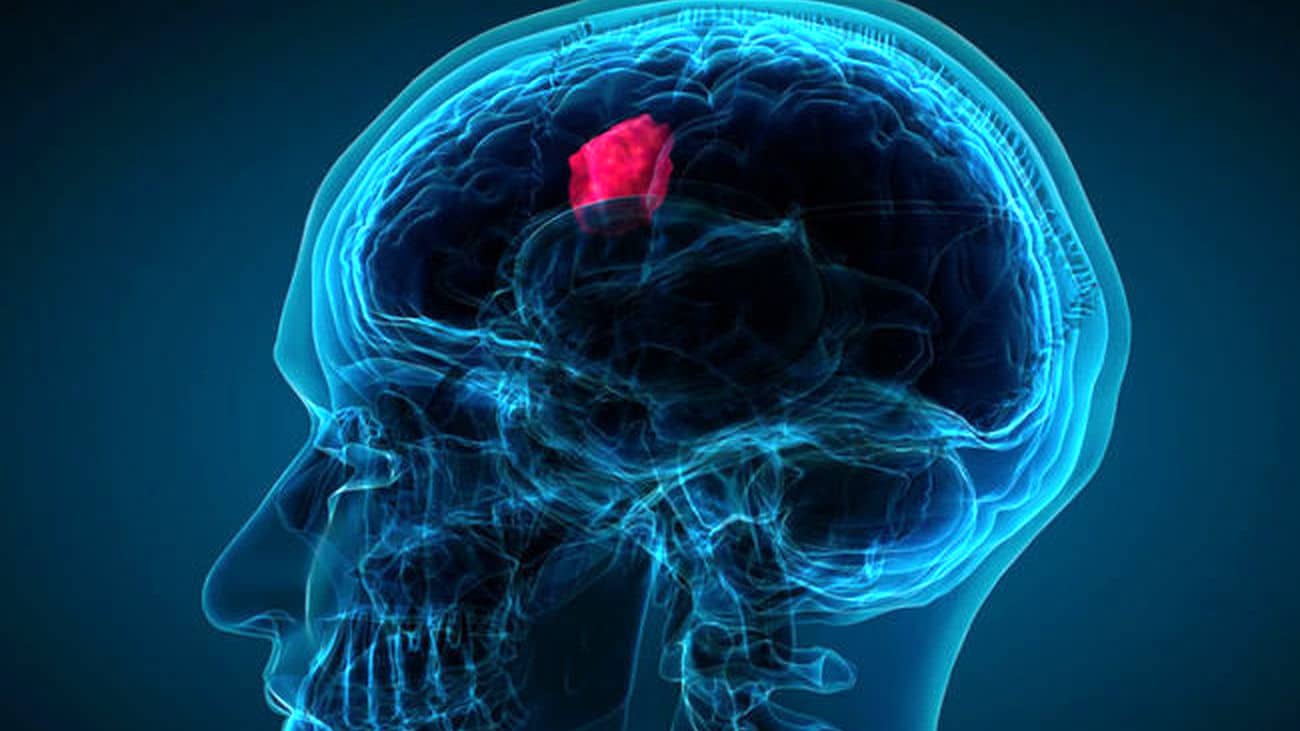 baş ağrısı beyin tümörü