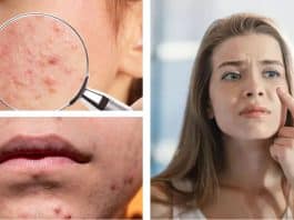 Geçmeyen sivilcenin