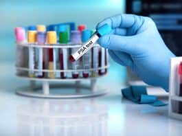 Prostat psa testi