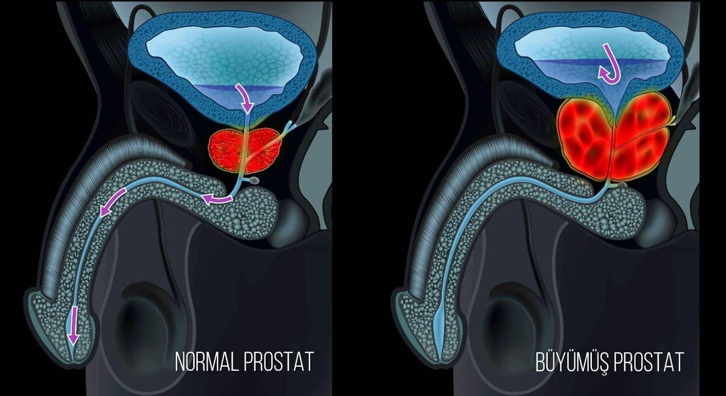 İyi huylu prostat büyümesi