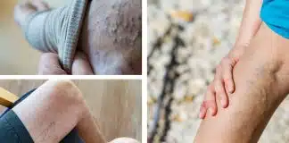 Varis erken tedavi edilirse başarı şansı daha yüksek Varis erken tedavi