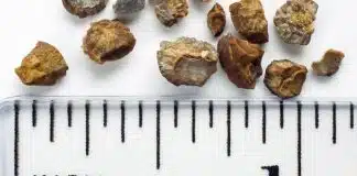 Böbrek taşı hastalığına neden olan 8 önemli hata! böbrek taşı