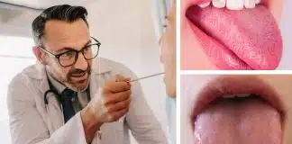 Dil rengi değişikliği hangi hastalıkların belirtisi olabilir? Dil rengi değişikliği