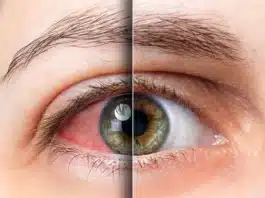 Diyabetik Retinopati