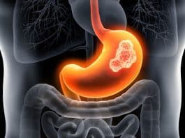 mide kanseri belirtisi