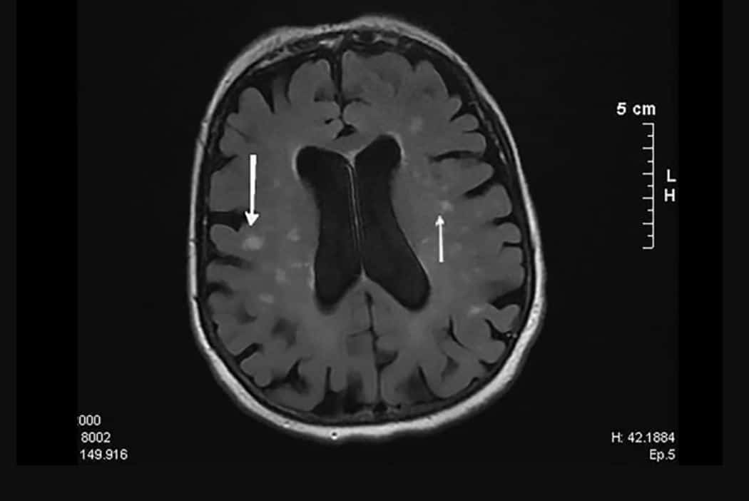 b12 levels brain