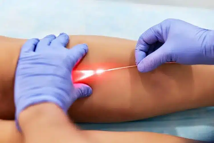 endovenous laser treatment