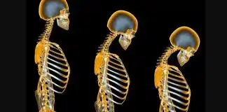 Osteoporoz: Düzenli kemik yoğunluğu ölçümleri yaptırın Osteoporoz