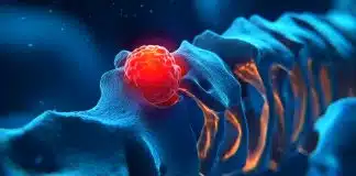 Kemik metastazı nedir? Uykudan uyandıran ağrıya dikkat! Kemik metastazı
