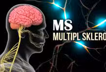 MS Multipl Skleroz