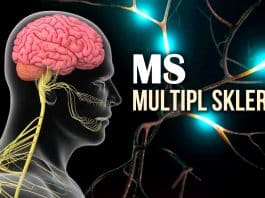 MS Multipl Skleroz