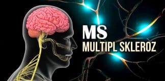 MS Multipl Skleroz