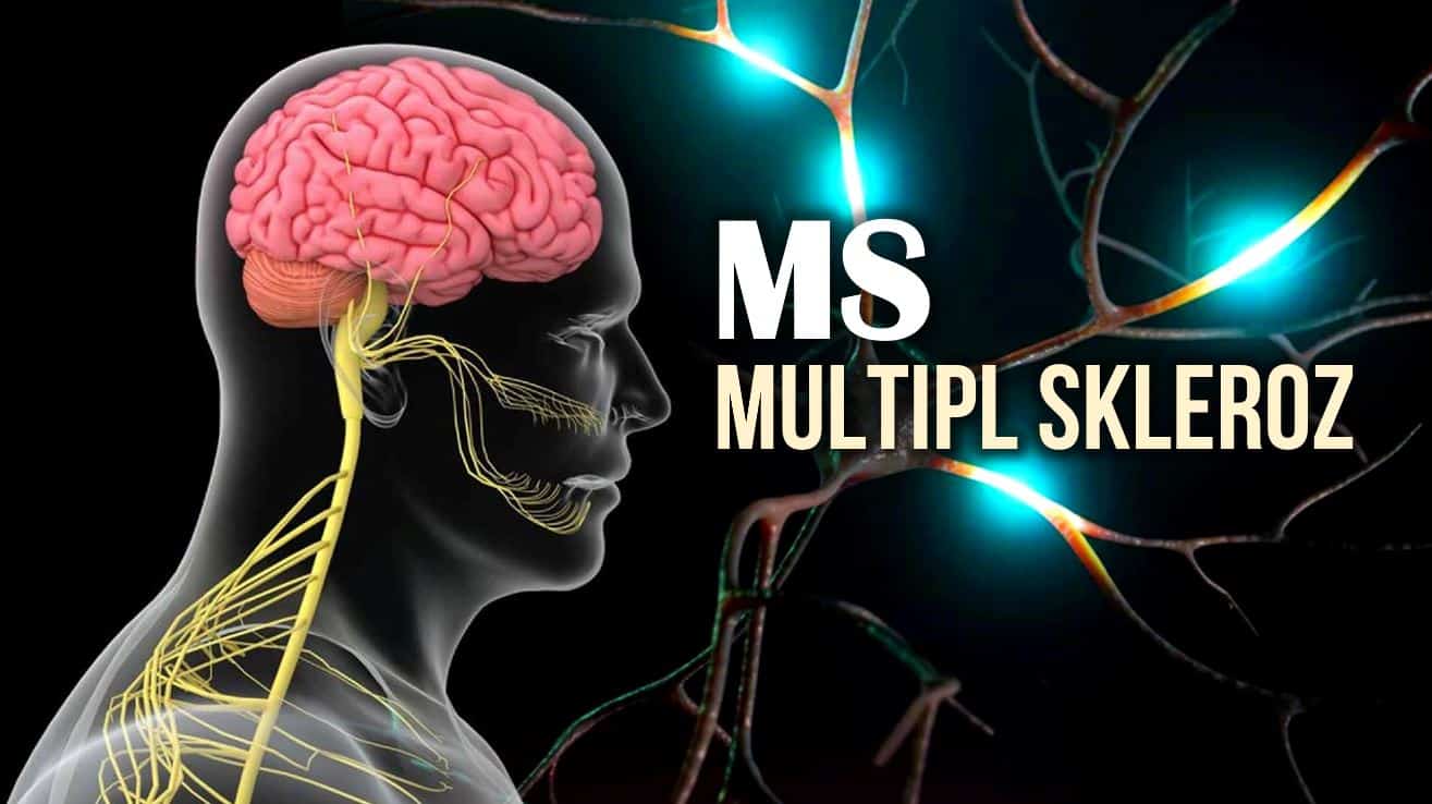 MS Multipl Skleroz