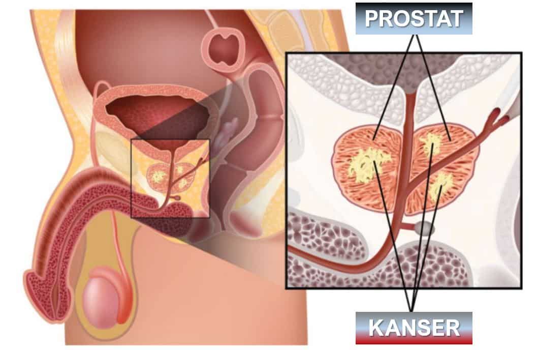 PROSTATE cancer