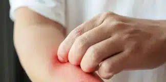 Egzama için dermatolog önerileri: Etkili bakım ve tedavi yolları Egzama için dermatolog
