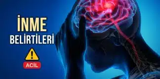İnme olduğu nasıl anlaşılır, ilk belirtiler neler? 4,5 saat kritik! inme belirtiler