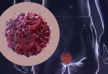 testis kanseri