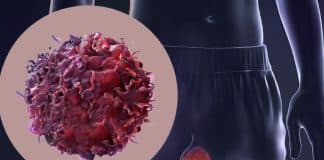 testis kanseri