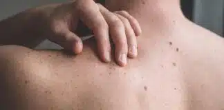 Cilt lekeleri: Ne zaman endişelenmeliyiz? Cilt lekeleri