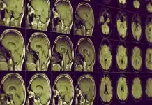 alzheimer lityum